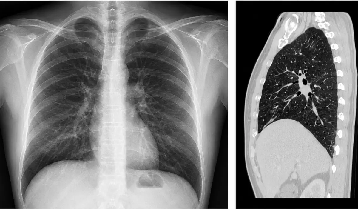 CT Scan of Lungs