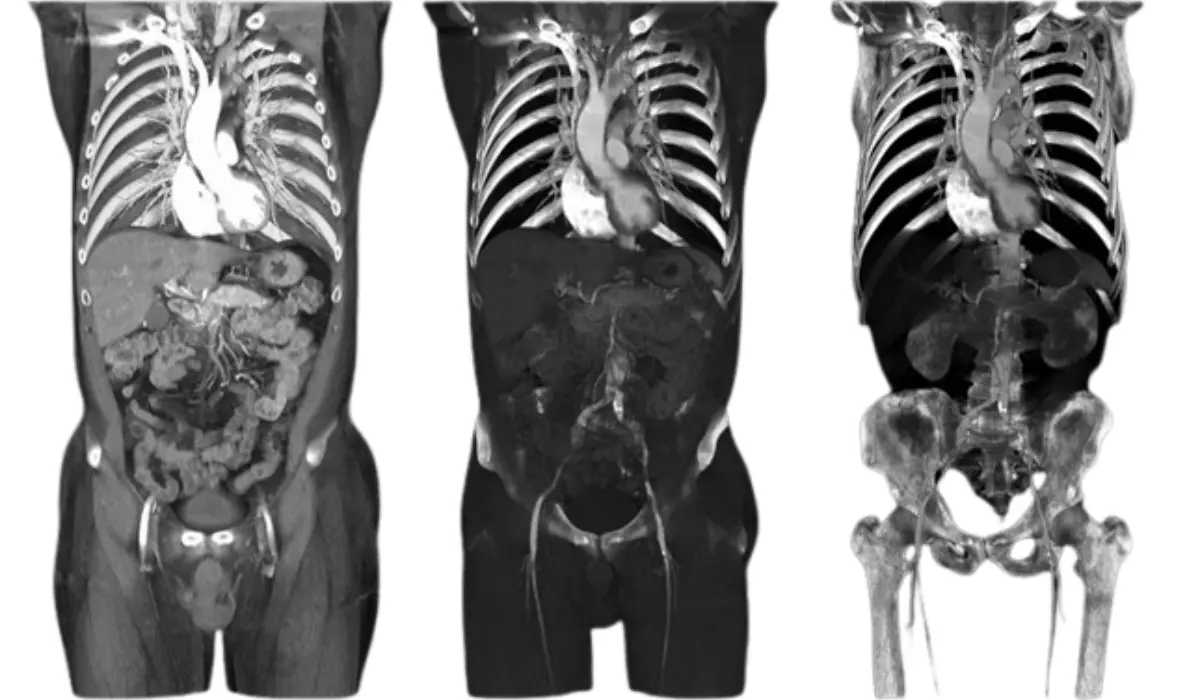 CT Scan Of The Pelvis: Before, During, And After