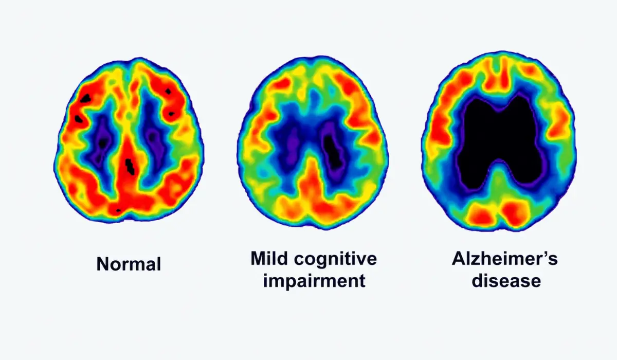 Amyloid PET Scan: Benefits, Risks, And What To Expect