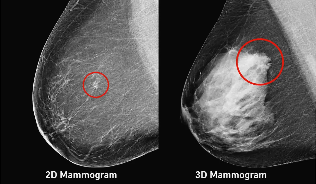 Bilateral vs. 3D Mammogram: Which Screening Fits You?