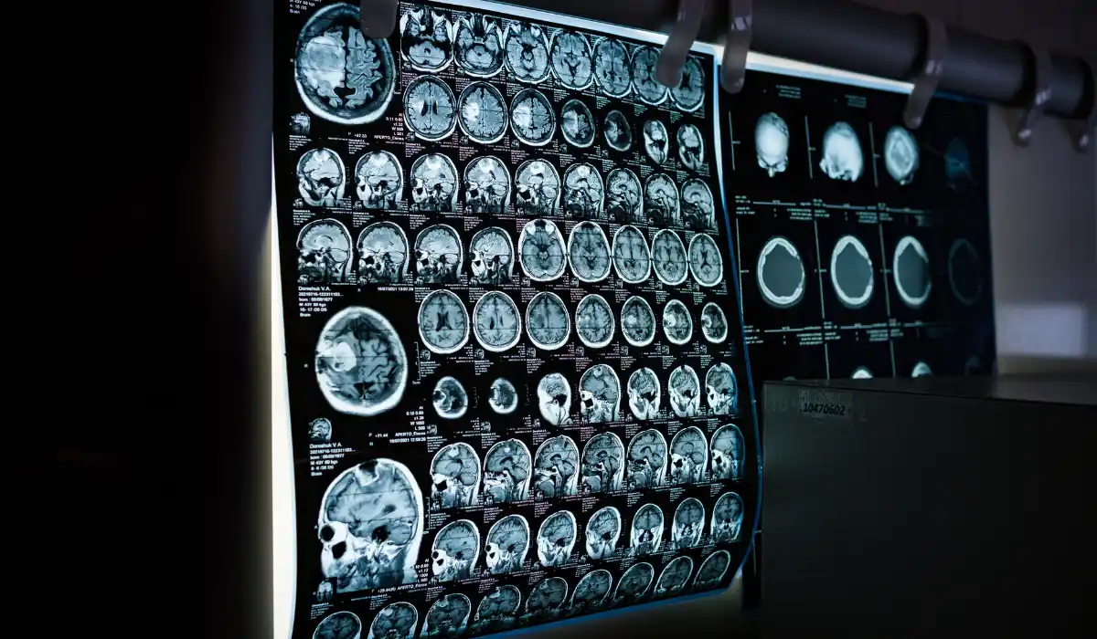 Digital Subtraction Angiography: Purpose, Procedure, Risks, and Results