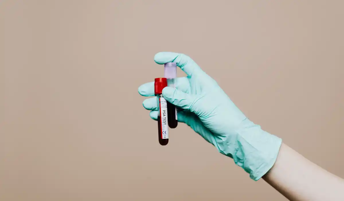How to Lower PSA Before Test: Safe Steps for Accurate Results