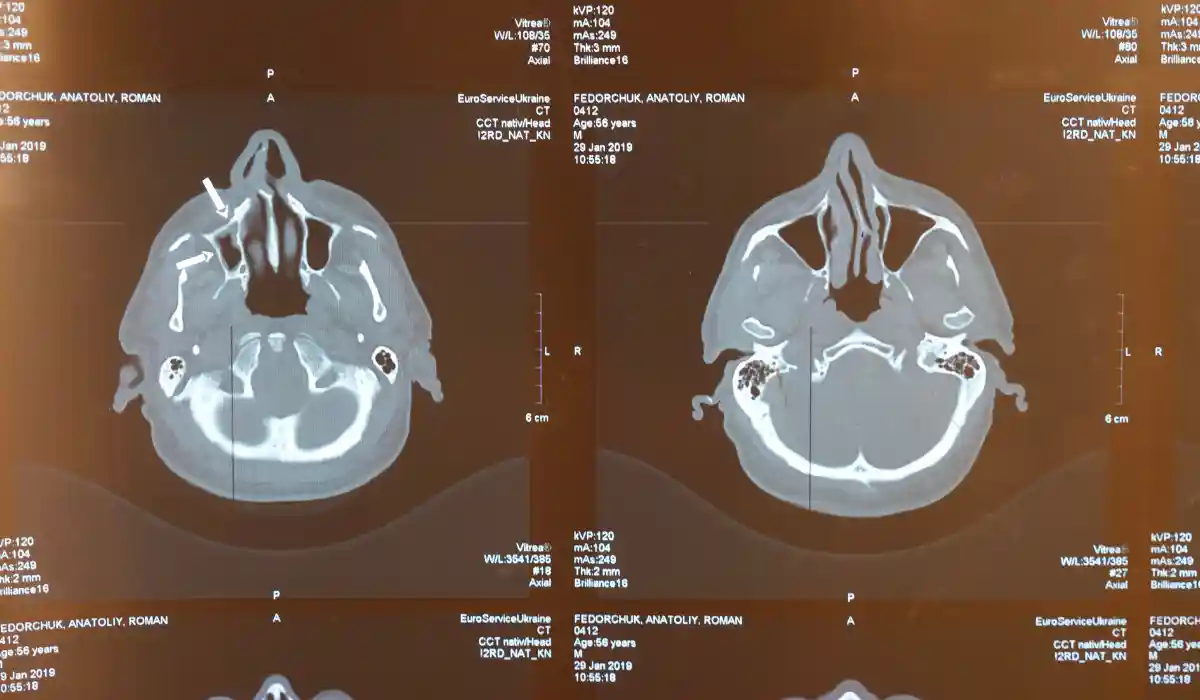 MRA vs MRI: What Is The Difference And Which Scan Is Used?