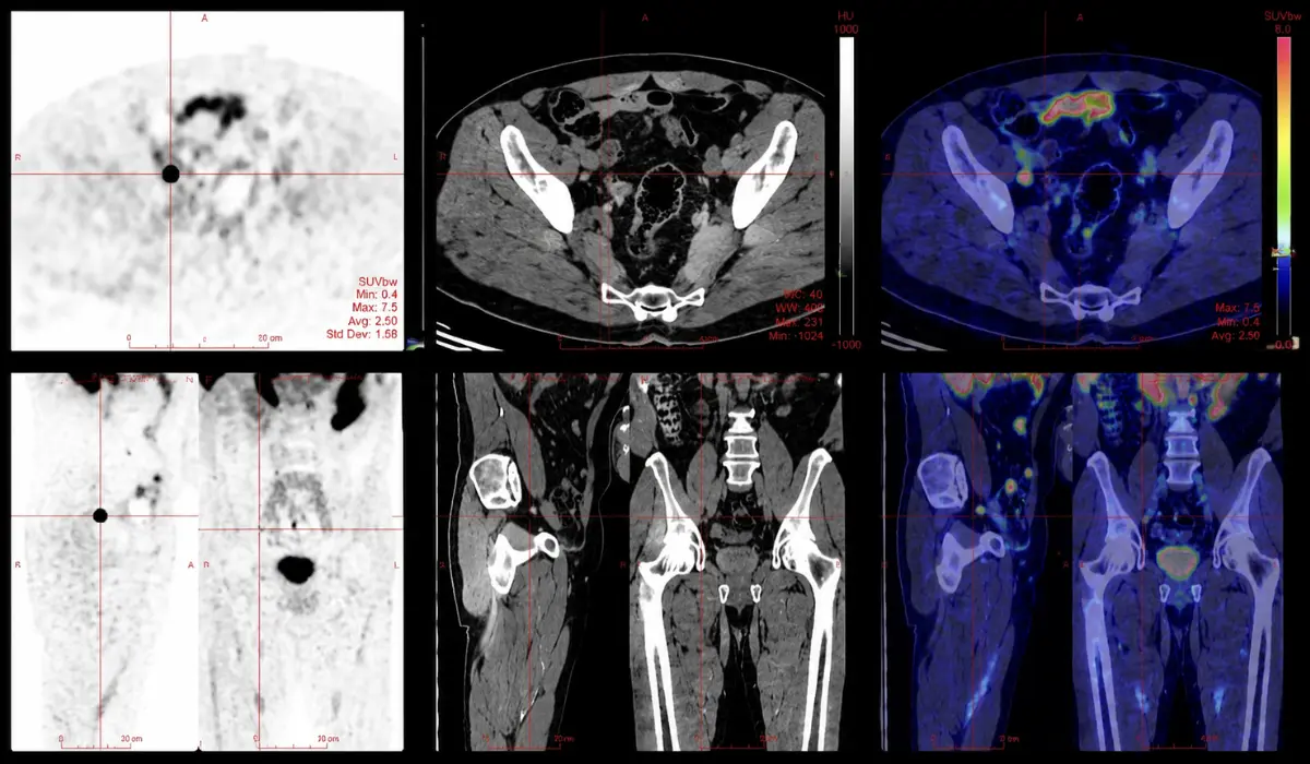 PSMA PET Scan For Prostate Cancer: How It Improves Diagnosis?