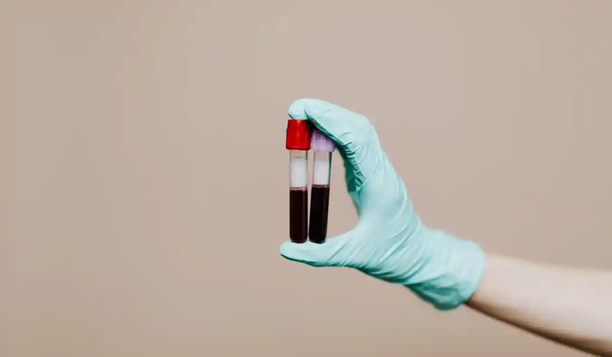 Do You Need to Fast for a PSA Test?