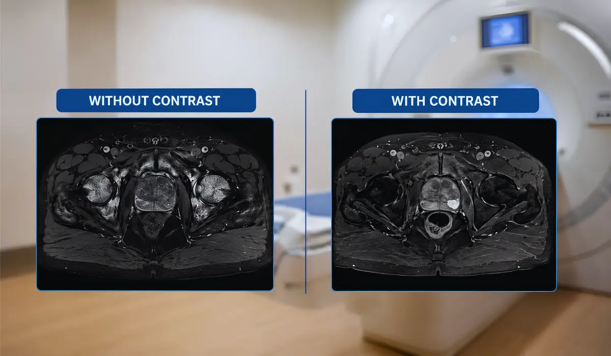 Prostate MRI With And Without Contrast: What Patients Should Know?
