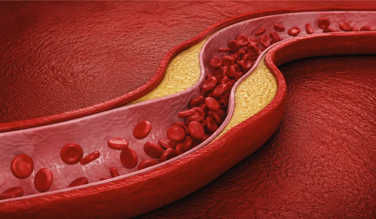 what is mixed hyperlipidemia